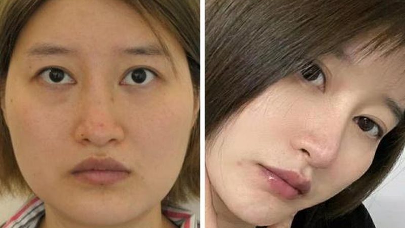 医美耗材批发厂家直供，揭秘背后的行业秘密