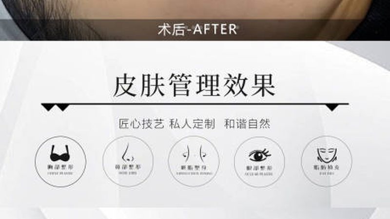 激光祛斑需要做几次