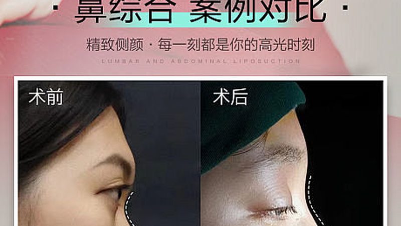 皮秒激光祛黄褐斑，揭秘治疗次数之谜**