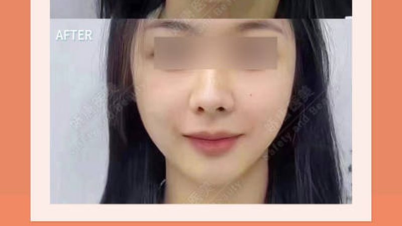 揭秘光子嫩肤与激光祛斑：价格差异背后的真相