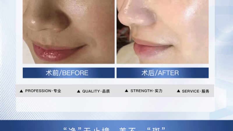 小标题：肉毒素注射间隔时间缩短的影响