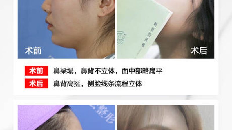 广州光子嫩肤与超光子：揭秘团购价格背后的差异
