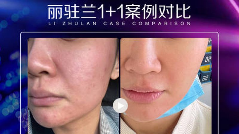 在进行激光美容前，需注意以下几点：