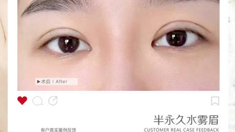 光子嫩肤VS强脉冲光：价格差异背后的技术解析