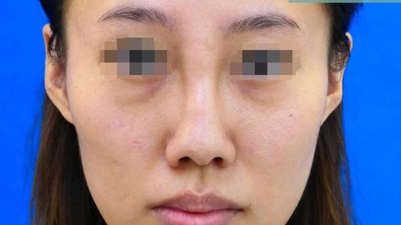 隆鼻，如何实现面部协调之美？价格解析**